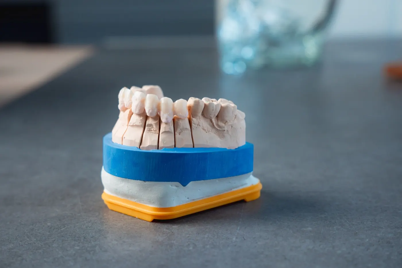 Gipsmodell mit Zahnkranz im Dentallabor Starlab Dental